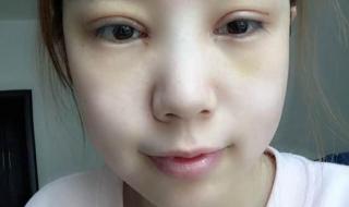 双眼皮全切图片 双眼皮全切图片